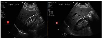 Comparing effects of beetroot juice and Mediterranean diet on liver enzymes and sonographic appearance in patients with non-alcoholic fatty liver disease: a randomized control trials